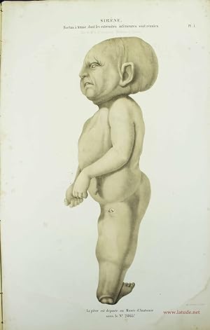 Musée d'anatomie de la Faculté de médecine de Strasbourg. Description de deux foetus monstres, do...