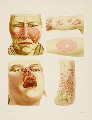 Traité pratique, théorique et thérapeutique de la scrofulo-tuberculose de la peau et des muqueuse...