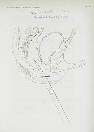 Observation d'imperforation de l'anus et de l'urètre. (Extrait des Mémoires de l'Académie Royale ...