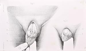 Des vices de conformation de l'urèthre chez l'homme et des moyens d'y remédier. Thèse présentée a...