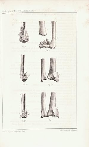 Mémoire sur les fractures de l'extrémité inférieure du radius. In : Archives générales de médecin...