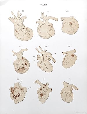 Etude sur les affections congénitales du coeur (Atlas).
