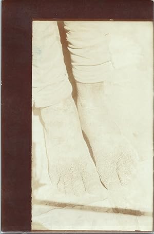 Ethiopie, Harar, léproserie St-Antoine, pieds d'un lépreux