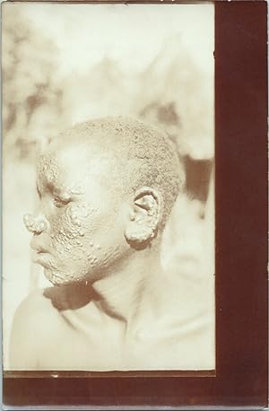 Ethiopie, Harar, léproserie St-Antoine, Ibro Sio, un lépreux guéri