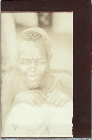 Ethiopie, Harar, léproserie St-Antoine, type de lépreux