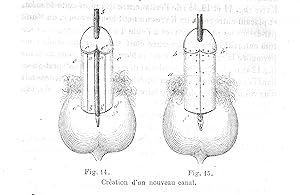 De l'hypospadias périnéo-scrotal et de son traitement chirurgical, In : Archives Générales de Méd...