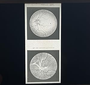 Twenty-one [21] Black and White Lantern Slides of a Range of Eye Diseases, Disorders and Conditions