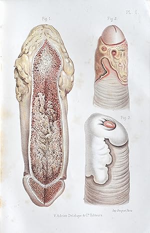 Maladies chirurgicales du pénis , par J.-N. Demarquay ; ouvrage publié par les docteurs G. Voelke...