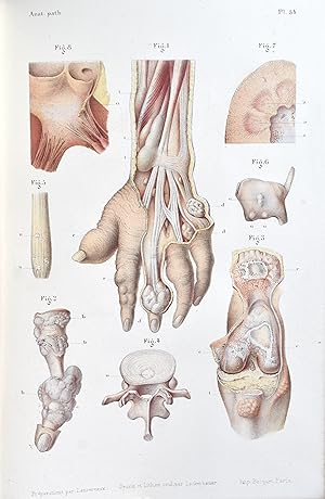 Atlas d'anatomie pathologique. Texte par M. Lancereaux. Atlas par le Dr. Lancereaux et M. Lackerb...