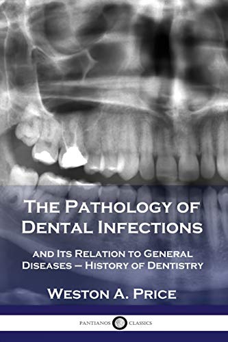 

The Pathology of Dental Infections: and Its Relation to General Diseases - History of Dentistry