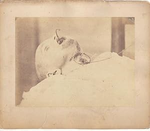 Photographie médicale d'un cadavre d'enfant ayant succombé à une trachéotomie. Circa 1875