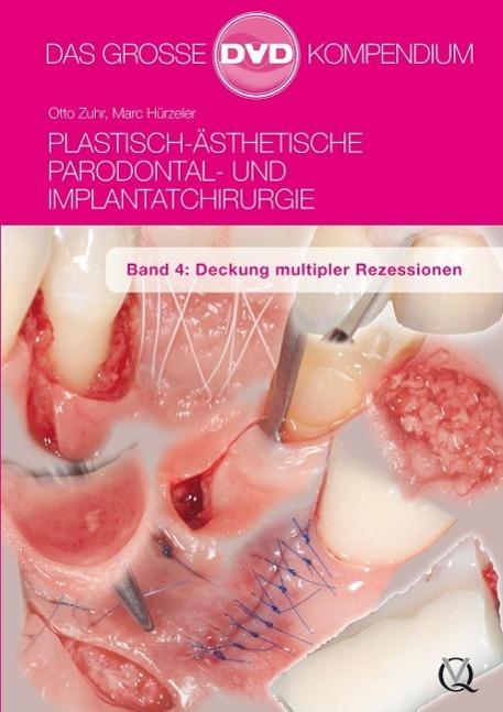 Plastisch-Ästhetische Parodontal- und Implantatchirurgie : Band 4: Deckung multipler Rezessionen - Otto Zuhr