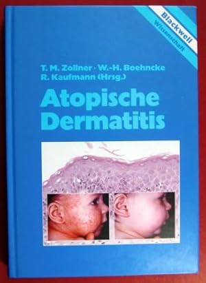 Atopische Dermatitis.