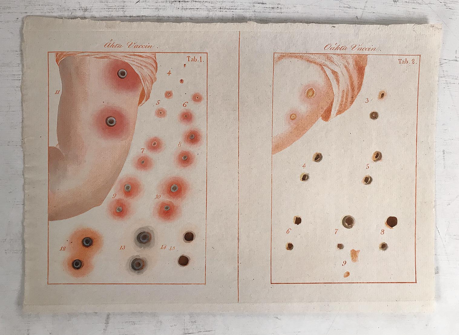 Om smitt-koppor och förwaringsmedel deremot [On smallpox and their treatment]. [=caption]. HEDIN, SVEN. [Assez bon] [Couverture souple]