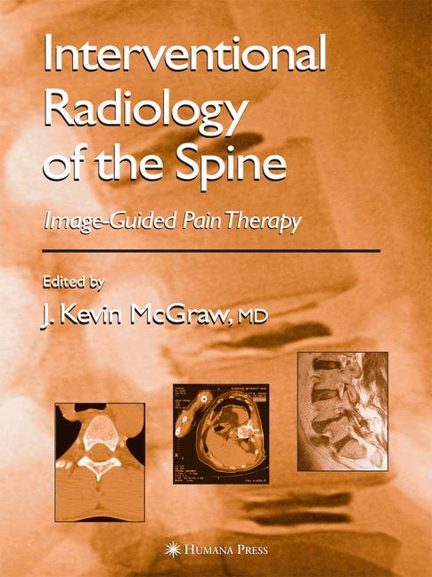 Interventional Radiology of the Spine - McGraw, Kevin J.
