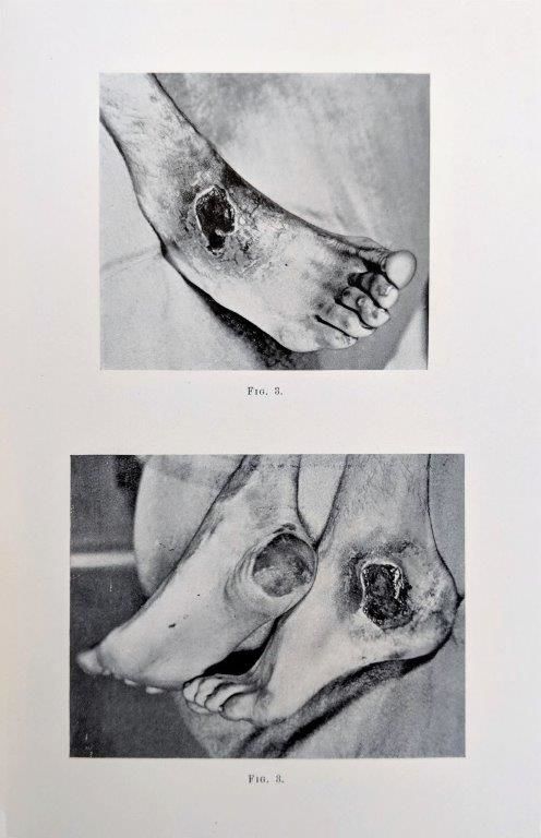 A Case of Multiple Gangrene in Malarial Fever (With illustrations). [Offprint]. OSLER, Sir William (1849-1919). [ ] [Couverture souple]