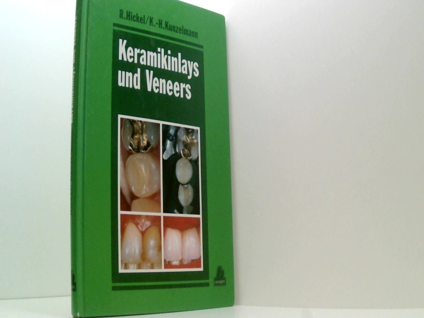 Keramikinlays und Veneers - Hickel, Reinhard und Karl-Heinz Kunzelmann