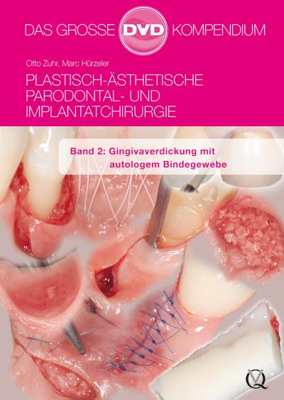 Plastisch-Ästhetische Parodontal- und Implantatchirurgie / Plastisch-Ästhetische Parodontal- und Implantatchirurgie : Gingivaverdickung mit autologem Bindegewebe, Das große DVD-Kompendium, Lehr-Programm, DVD-Video, Plastisch-Ästhetische Parodontal- und Implantatchirurgie 2 - Marc Hürzeler