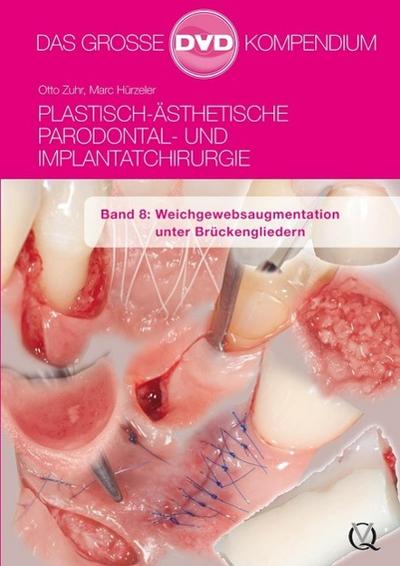 Plastisch-Ästhetische Parodontal- und Implantatchirurgie / Plastisch-Ästhetische Parodontal- und Implantatchirurgie : Weichgewebsaugmentation unter Brückengliedern, DVD, Plastisch-Ästhetische Parodontal- und Implantatchirurgie 8 - Otto Zuhr