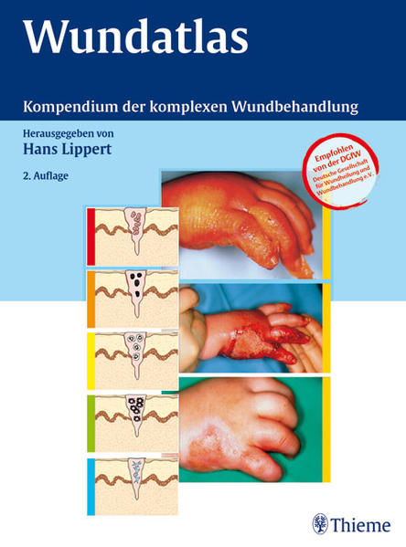 Wundatlas: Kompendium der komplexen Wundbehandlung - Lippert, Hans