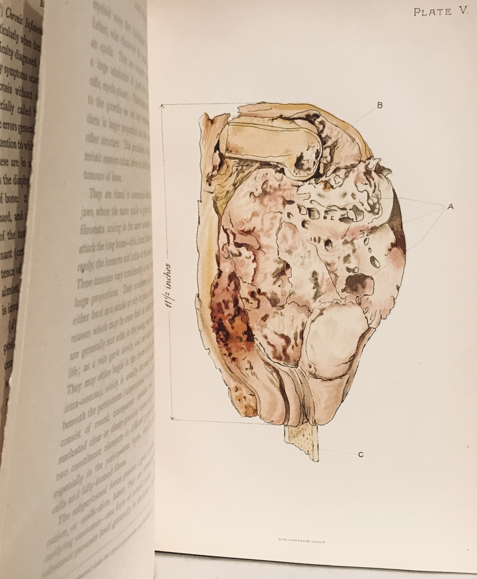 Diseases of the Bones. Their Pathology, Diagnosis, and Treatment. by ...