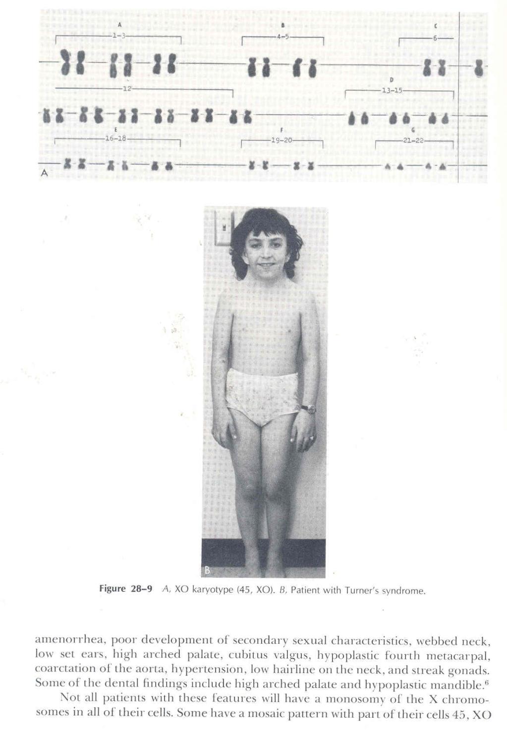 Clinical pedodontics. [The children's dentisthis practice & his community ; Parent counseling & child behavior-- Child management in the dental office; Morphology of the primary teeth; Diagnosis & treatment planning for the child patient; Roentgenography; The problem of pain & sedation; Operative dentistry for children; Properties & uses of restorative materials; Pulpal treatment of primary teeth; The care of injuries to the anterior teeth of children; Removable partial dentures for children; Periodontal diseases in children; Face development & tooth eruption-- Preliminary steps in preventive orthodontics; Preventive orthodontics; Oral habits in children; Oral surgery for children; Antimicrobial agents; Epidemiology of dental caries; etc] - Finn, Sidney B. (Sidney Bernard), 1908-1979 ; Akin, Johnnye. [Sidney B Finn Stanley E Keller Lincoln R Manson-Hing Roland R Hawes Joseph M Sim Satish R Rao Gilbert J Parfitt Thompson M Lewis David B Law Louis W Ripa H Perry Hitchcock Charles A McCallum Jr Joseph F Volker David L Russell Joe Price Thomas Gwenyth R Vaughn Johnnye Akin Palmi Moller Sara C. Finley Wayne Finley]