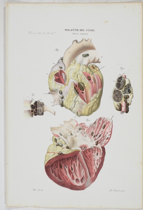 Malattie del Cuore. 14 Tafeln aus Atlante Generale della Anatomia