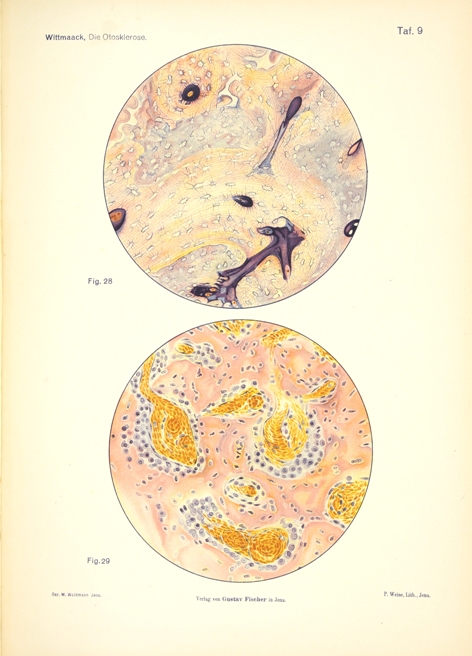 Die Otosklerose Auf Grund Eigener Forschungen By Wittmaack Karl 1919 Antiq F D Sohn Medicusbooks Com