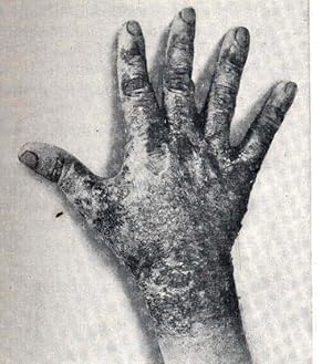 Bild des Verkufers fr A manual of tropical medicine [Diseases caused by the arthropod-borne viruses; Enterovirus infections, including poliomyelitis; Other virus diseases of special importance or interest in tropical or subtropical areas; Ricketsial diseases; Epidemic typhus; Murine typhus; American spotted fevers; Related spotted fevers and rickettsioses; Rickettsialpox; North Queensland tick typhus; Scrub typhus; Trench typhus; Q fever; Spirochetal diseases; The relapsing fevers; Yaws and bejel; Pinta; The leptospiral diseases; Rat-bite fevers; Sodoku --- Haverhill fever; Bacterial diseases; The Diarrheal diseases; Bacillary dysentery; shigellosis; Food poisoning; Botulism; Staphylococcus; Strptococcus; Salmonella; Clostridium Perfringens; Cholera; Brucellosis zum Verkauf von Joseph Valles - Books