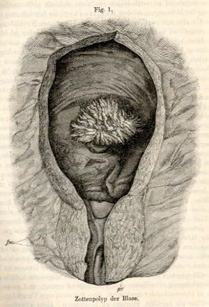 Bild des Verkufers fr Ueber Harnblasengeschwlste und deren Behandlung. zum Verkauf von Antiq. F.-D. Shn - Medicusbooks.Com