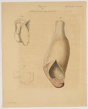 Bild des Verkufers fr Hydrocele. H. Induratio tunicae vaginalis testis. Zur Erluterung der gutartigen Vernderungen der Scheidenhaut des Hodens. zum Verkauf von Antiq. F.-D. Shn - Medicusbooks.Com