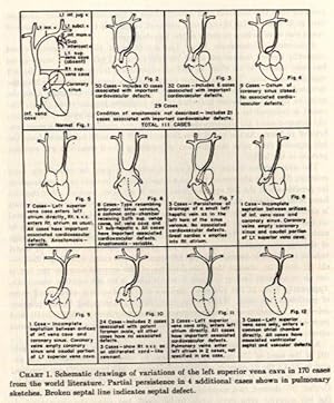 Bild des Verkufers fr Persistent left superior Vena cava. Survey of world literature and report of thirty additional cases. zum Verkauf von Antiq. F.-D. Shn - Medicusbooks.Com