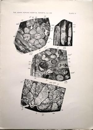 Bild des Verkufers fr The Structure of Normal Fibres of Purkinje in the Adult Human Heart and Their Pathological Alteration in Syphilitic Myocarditis. The Johns Hopkins Hospital Reports. Volume XIX, FASCICULUS 1. zum Verkauf von Patrick Pollak Rare Books ABA ILAB