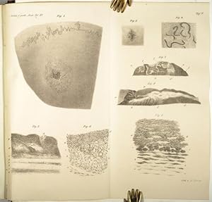 Bild des Verkufers fr Ueber die Natur der constitutionell-syphilitischen Affectionen (pp.217-336, 1 Taf. mit 8 Fig.). zum Verkauf von Antiq. F.-D. Shn - Medicusbooks.Com