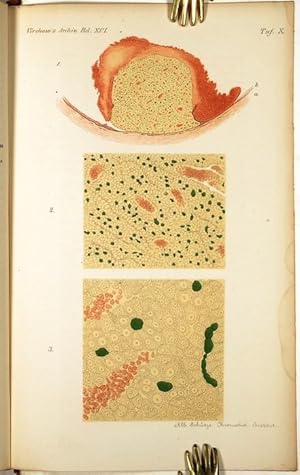 Bild des Verkufers fr Ueber einen sarcomartigen, Billverdin enthaltenden Tumor der Chorioidea (pp.442-448, 1 Taf). zum Verkauf von Antiq. F.-D. Shn - Medicusbooks.Com