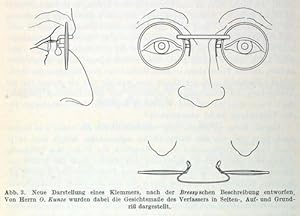 Bild des Verkufers fr J. Bressys Klemmer aus dem Jahre 1925 (pp.97-101, 3 Abb.). zum Verkauf von Antiq. F.-D. Shn - Medicusbooks.Com