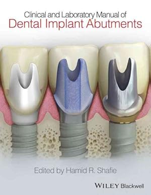 Image du vendeur pour Clinical and Laboratory Manual of Dental Implant Abutments mis en vente par GreatBookPrices