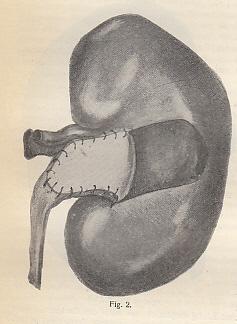 Bild des Verkufers fr ber die Sicherung der Naht bei Pyelolithotomie durch einen gestielten Lappen der Capsula fibrosa. IN: Zbl. Chir., 39/44., S. 1505-1509, 2 Fig., 1912, Br. zum Verkauf von Antiquariat Michael Eschmann
