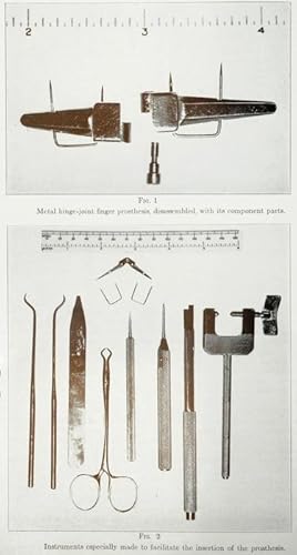 Experiences with a finger-joint prothesis (pp.87-102, 40 Abb.).