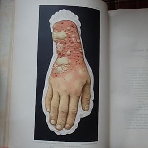 A Pictorial atlas of skin diseases and syphilitic affections: In Photo-lithochromes from Models i...