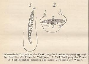 Zur operativen Behandlung der Varicocele. Beschreibung eines neuen Verfahrens. IN: Berl. klin. Ws...