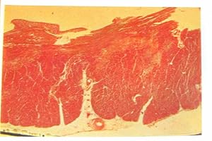 L'infarctus du myocarde