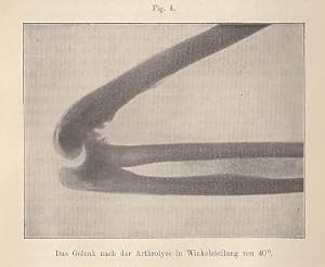 Die Arthrolyse und die Resection des Ellenbogengelenks. IN: Verh.dtsch.Ges.Chir., 1901, 30, S. 67...