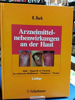 Arzneimittelnebenwirkungen an der Haut: Klinik - Diagnostik zur Erkennung der auslösenden Medikam...