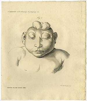 Antique Print-HUMAN ANATOMY-BRAINLESS CHILD-FOETUS-Sandifort-Veelwaard-1823