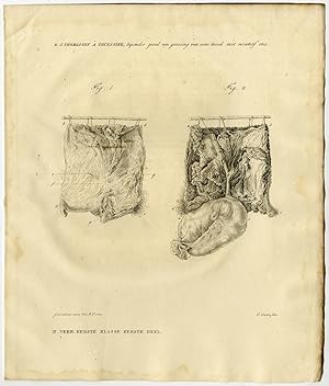 Antique Print-HUMAN ANATOMY-ARTIFICIAL ANUS-Thomassen-Sluyter-1827