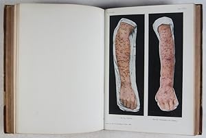 Atlas der Hautkrankheiten mit Einschluss der wichtigsten Venerischen Erkrankungen für praktische Aerzte und Studierende by Jacobi, E.: g+ to vg Hardcover (1904) Second edition. | ERIC CHAIM KLINE, BOOKSELLER (ABAA ILAB) Atlas der Hautkrankheiten mit Einschluss der wichtigsten Venerischen Erkrankungen für praktische Aerzte und Studierende by Jacobi, E.: g+ to vg Hardcover (1904) Second edition. | ERIC CHAIM KLINE, BOOKSELLER (ABAA ILAB)