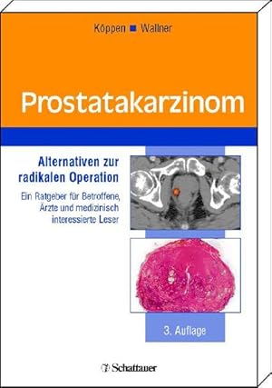 Bild des Verkufers fr Prostatakarzinom: Alternativen zur radikalen Operation Ein Ratgeber fr Betroffene, rzte und medizinisch interessierte Leser zum Verkauf von Antiquariat Armebooks