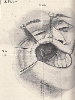 Bild des Verkufers fr Ein neuer Weg fr die Operation der malignen Nasentumoren. IN: Mnchener Medizinische Wochenschrift Heft 20, S. 953-956, 2 Abb., 1906, Br. zum Verkauf von Antiquariat Michael Eschmann