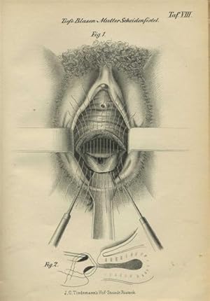 Ueber die Operation der Blasen-Scheidenfisteln durch die blutige Naht mit Bemerkungen über die He...
